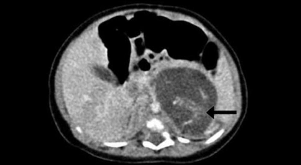 جنين داخل جنين