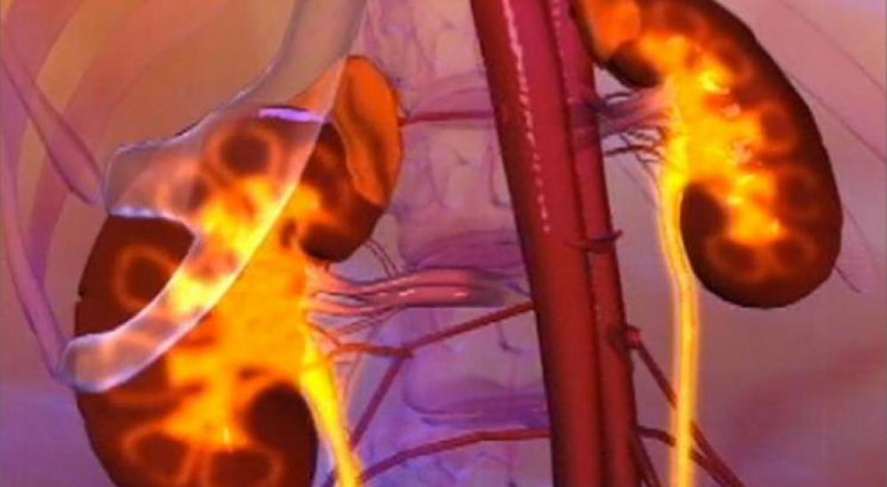 2.3 مليون مريض بالفشل الكلوي يموتون سنويا