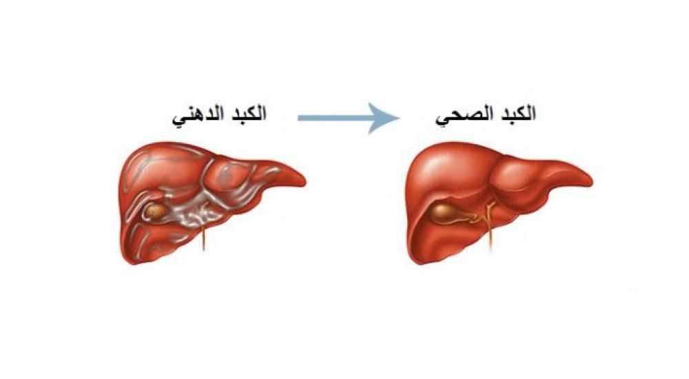مقارنة بين الكبد الصحي والكبد الدهني