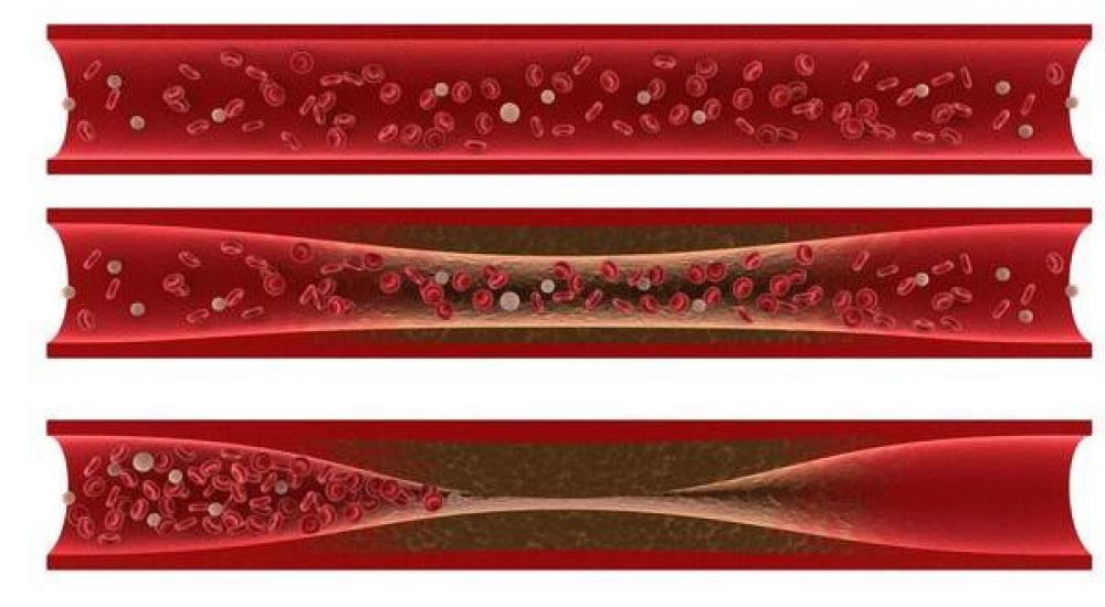 رسم توضيحي لتصلب الشرايين