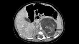 جنين داخل جنين