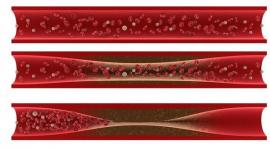 رسم توضيحي لتصلب الشرايين