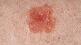 dermnet_photo_of_bowens_disease