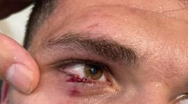 وادي تعرض لجرح طولي وقطعي في الجفن السفلي للعين