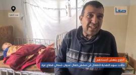 الجوع ينهش أجسادهم.. "صفا" ترصد حالات سوء التغذية لأطفال في مشفى كمال عدوان شمالي قطاع غزة