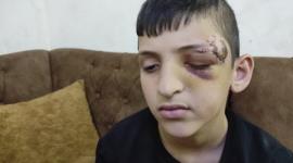 أمير الحداد.. طفل من مخيم شعفاط بالقدس أصابه الاحتلال برصاصة استقرت بين الدماغ والعين