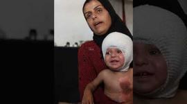 إصابة الرضيع محمد حجيلة بحروق شديدة جراء قصف إسرائيلي على غزة