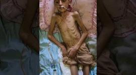 الطفل عبيدة أصيب بالشلل ويعاني سوء التغذية في غزة