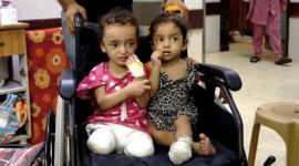 الصحة: 6000 حالة بتر في غزة تحتاج إلى برامج تأهيل عاجلة