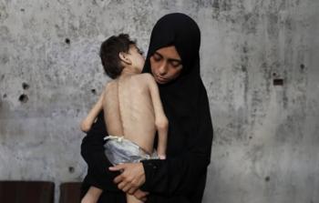 الصحة العالمية: سوء التغذية يسلك مسارًا خطيرًا في غزة