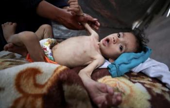 مدير الإغاثة الطبية في غزة: الأطفال والحوامل يعانون من سوء التغذية