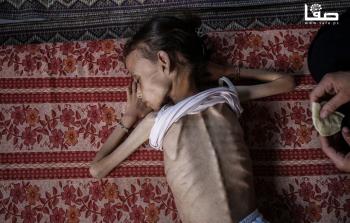 الصحة: 3 حالات وفاة نتيجة سوء التغذية بغزة خلال 24 ساعة