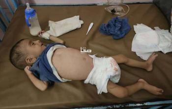 453 شهيدًا نتيجة المجاعة وسوء التغذية بغزة