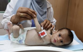 مجمع ناصر: 5500 طفل بحاجة للعلاج خارج غزة