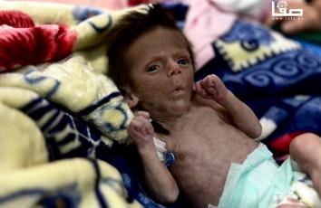 أطفال غزة يواجهون سوء التغذية بسبب نقص الدواء والغذاء وسط تزايد الحالات