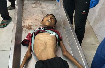 استشهاد مواطنين من خان يونس جنوبي قطاع غزة نتيجة سوء التغذية