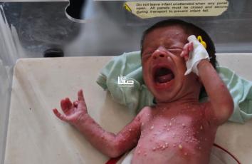 رضيع يعاني من سوء تغذية وطفح جلدي في غزة