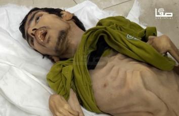 وفاة مواطن في خان يونس بسبب سوء التغذية بغزة