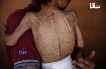 بسبب المجاعة واستمرار إغلاق المعابر.. الطفل يزن أبو فول يعاني سوء التغذية في مخيم الشاطئ غربي مدينة غزة