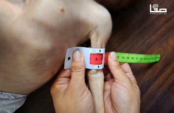 أطفال يعانون من سوء التغذية خلال فحصهم في أحد النقاط الطبية التابعة للأونروا بمدينة غزة