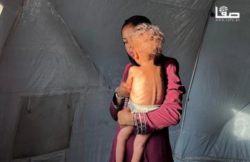 الطفل أدهم أبو عرمانة ما زال يعاني سوء التغذية في غزة