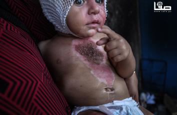 الرضيع محمد حجيلة يعاني حروقًا إثر إصابته في قصف إسرائيلي على مدينة غزة