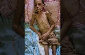 الطفل عبيدة أصيب بالشلل ويعاني سوء التغذية في غزة