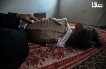 الطفلة مريم دواس (9 أعوام) من مدينة غزة تعاني سوء تغذية في ظل الحصار المفروض وحرب الإبادة على قطاع غزة