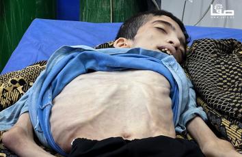 استشهاد كرم الجمل (25 عامًا) بسبب سوء التغذية في مستشفى العودة في مخيم النصيرات وسط مدينة غزة