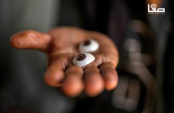 المواطن لؤي صبح (27 عامًا) فقد بصره وأُصيب بإعاقات دائمة خلال الحرب على غزة