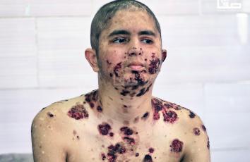 الشاب عبد الله الرقب (18 عامًا) يعاني من مرض الفقاع الشائع بعد إصابته برصاص الاحتلال ويتلقى العلاج في مجمع ناصر الطبي بمدينة خان يونس