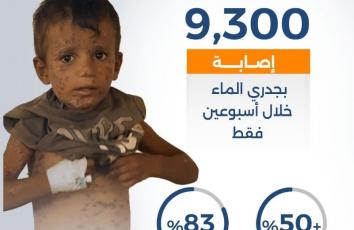 جدري الماء يتفشى بين نازحي غزة